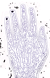 Spatulated hand
