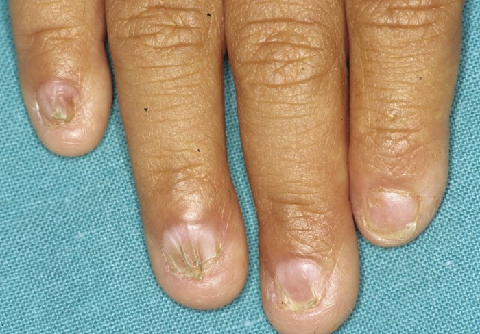 Sunken nails